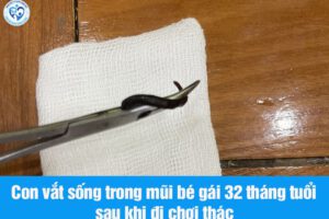 THƯỜNG XUYÊN CHẢY MÁU MŨI, GẦY SÚT CÂN – BÁC SĨ PHÁT HIỆN VẮT “KÝ SINH” TRONG MŨI BÉ GÁI 32 THÁNG TUỔI