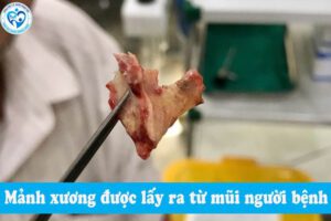 HÓC MẢNH XƯƠNG TRONG MŨI – BẠN CÓ TIN???